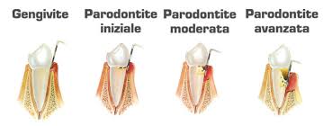 Paradontite
